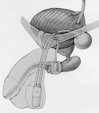 Atrificial Urinary Sphincter