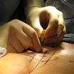 Interstim Needle Placement