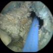 Prostate Radiation Necrosis and Stone Formation