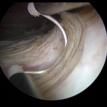 Prostate Resection