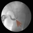 Proximal Bulbar Stricture RUG