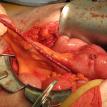 Catheterizable Bladder Augmentation