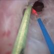 Tight Mid-bulb Urethral Stricture